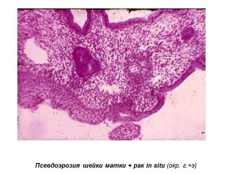 Псевдоэрозия шейки матки + рак in situ (окр. г.+э)